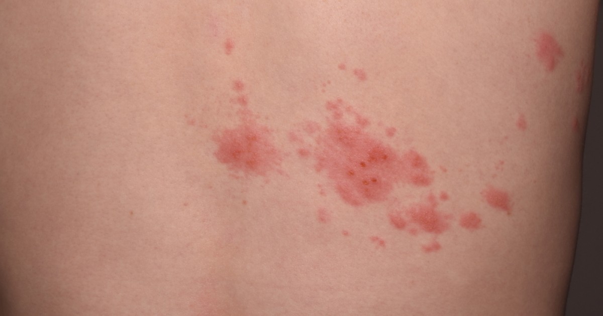 평촌 정형외과 대상포진 신경통, 신경 자극으로 생기는 통증 관리법 대표 이미지