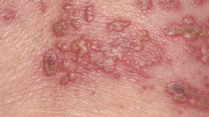 범계 대상포진 통증, 언제까지 이어질까 이미지