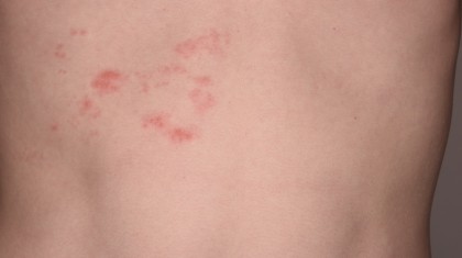 범계 정형외과 손·허벅지·허리 대상포진 증상 그리고 후유증 대처 이미지