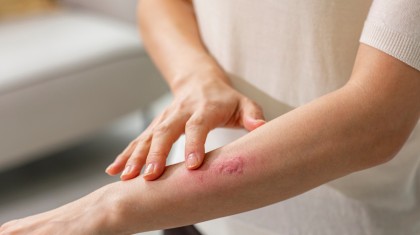 범계 호계동에서 알려드리는 대상포진 신경통 원인과 관리 방법 이미지