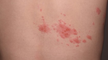 안양 정형외과 대상포진 후유증, 신경통이 계속되는 이유 이미지